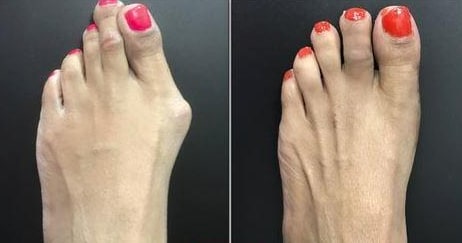 Orthopedic Toe Corrector For Hallux Valgus And Hammer Toe With Soft Washable Toe Spreader - Image 6