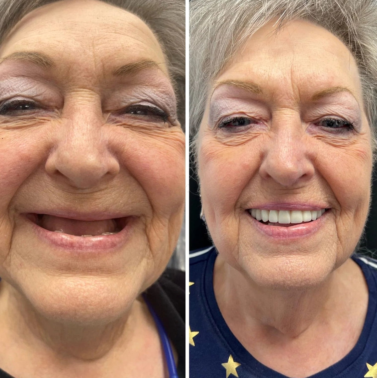 Reline Dentures With Soft Silicone For A Secure All-Day Fit - Image 2